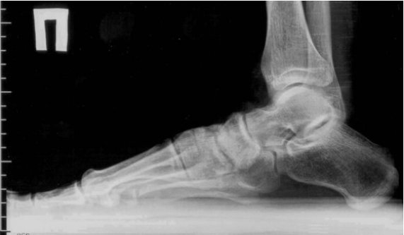 Arthrose der Zehen und Füße