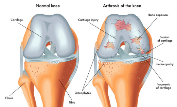 Normales Gelenk und durch Arthrose beeinflusst