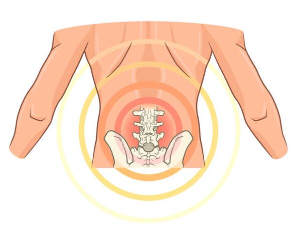 Osteochondrose der Lendenwirbelsäule